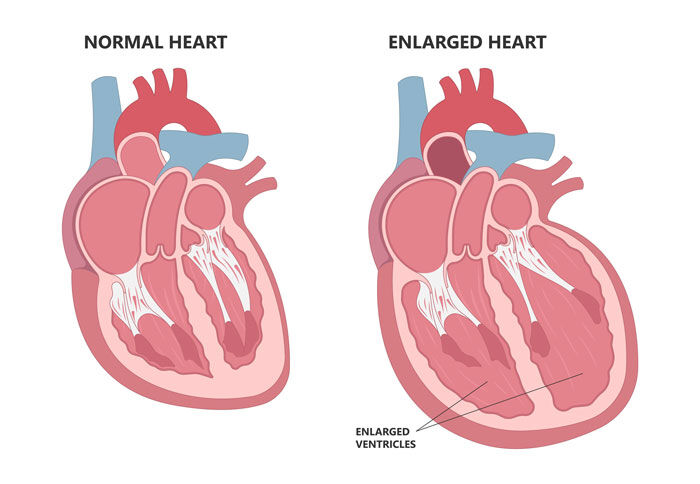 Enlarged Heart