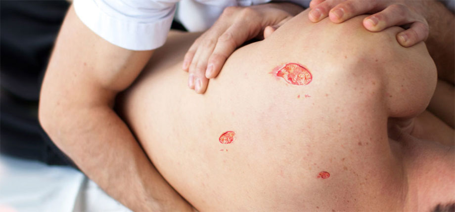 Bedsores: Causes, Symptoms, and Home Care Solutions