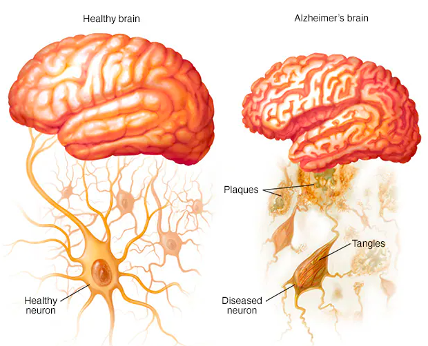 Understanding Alzheimer’s Disease: Causes, Symptoms, and At-Home Care Options
