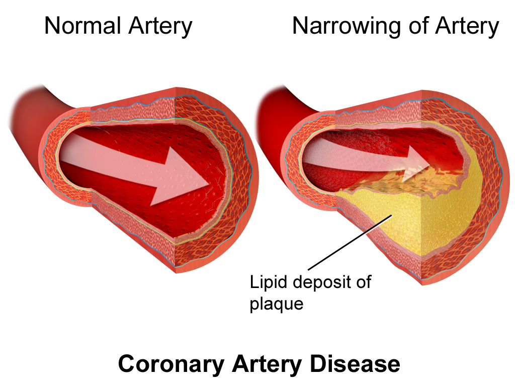 Coronary Artery Disease: Causes, Symptoms, and Home-Based Care Solutions