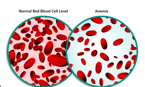 Anemia: Causes, Symptoms, and Home-Based Care Solutions
